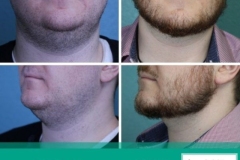 Face-Neck-B-A-4