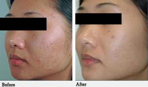 Acne Scar Treatment St. Petersburg & Clearwater