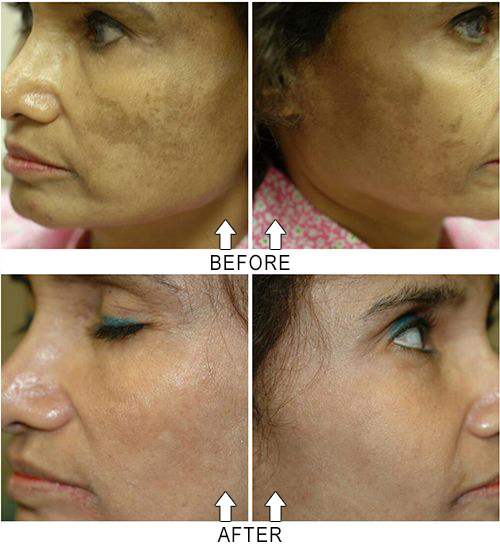 how use peel to chemical St. Peel  Chemical Peel Resurfacing Hetter Hetter Petersburg