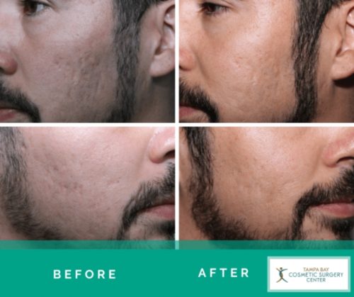 Acne-Scar-Treatment-1