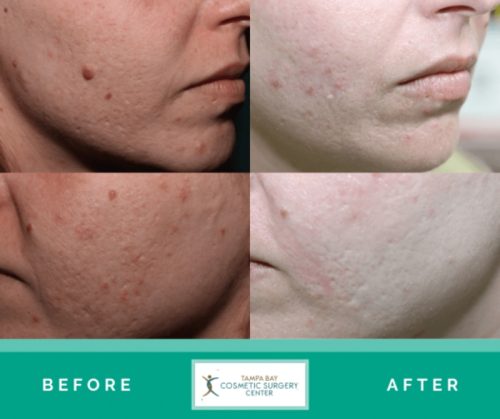 Acne-Scar-Treatment-3