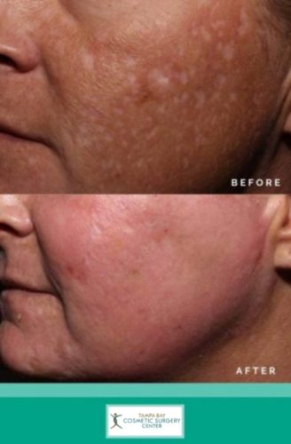 Acne-Scar-Treatment-5