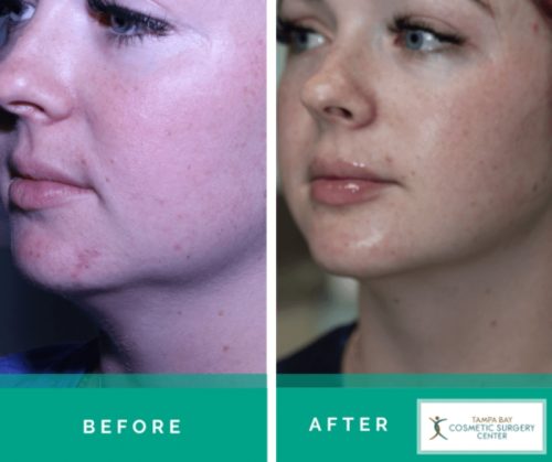 Acne-Scar-Treatment-6