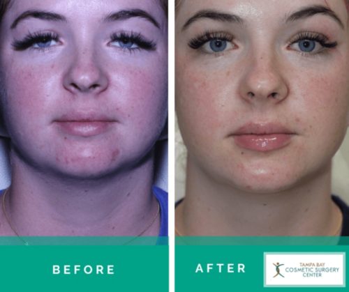 Acne-Scar-Treatment-7