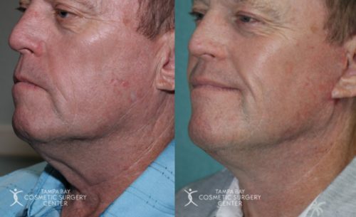 before-after-festoon-13 (1)