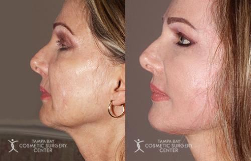 before-after-festoon-9