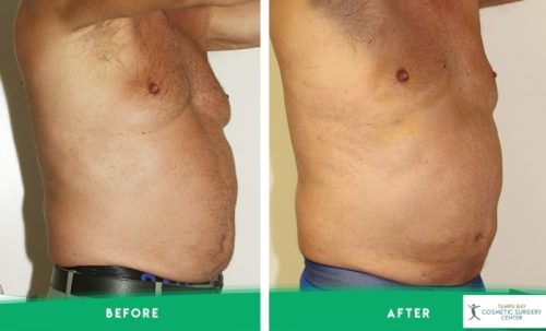 imgi 5 Male-Breast-Reduction.jpg