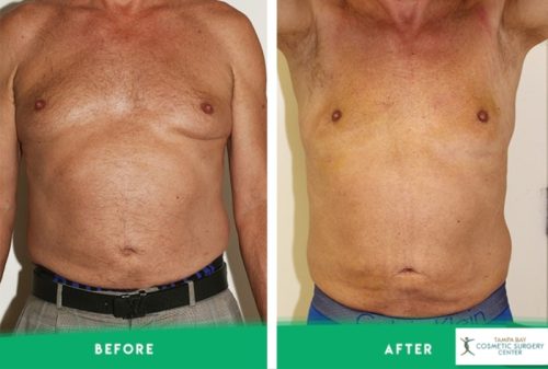 imgi 6 Male-Breast-Reduction-2.jpg