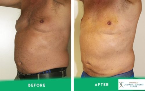 imgi 7 Male-Breast-Reduction 03.jpg