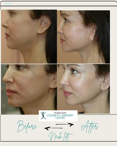 necklift-beofre-and-afters-side-view